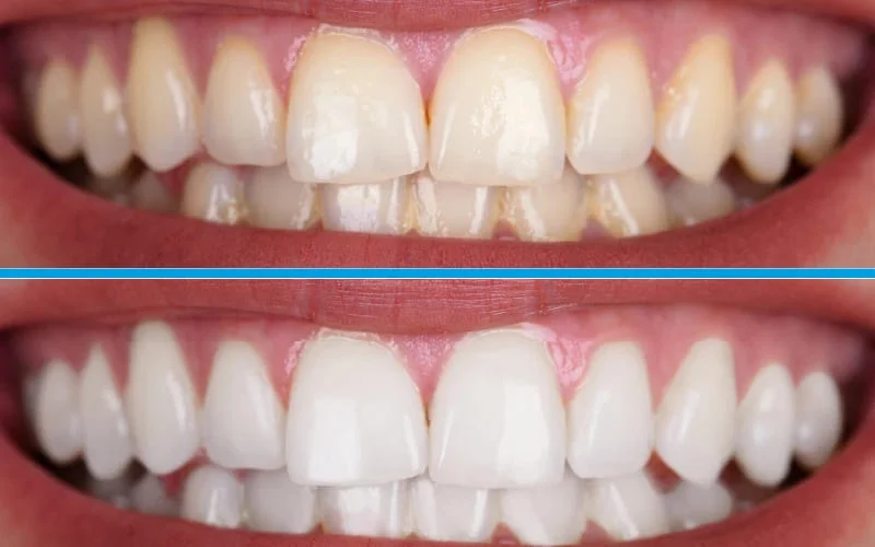 CLAREAMENTO DENTAL